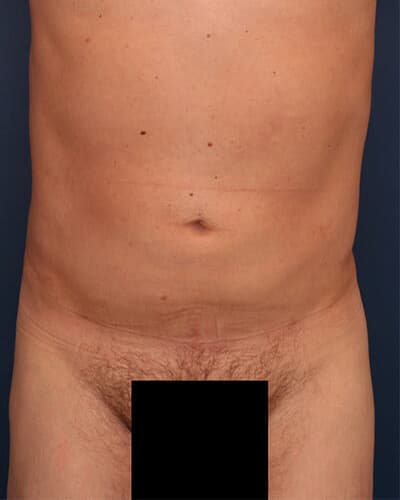 After Image: Fat Grafting - front
