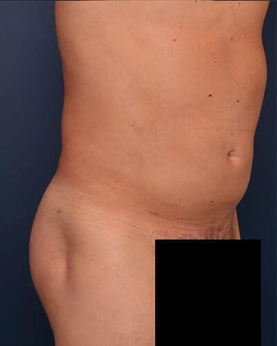 After Image: Fat Grafting - right-front-oblique