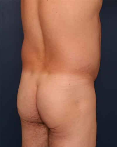 Before Image: Fat Grafting - right-back-oblique