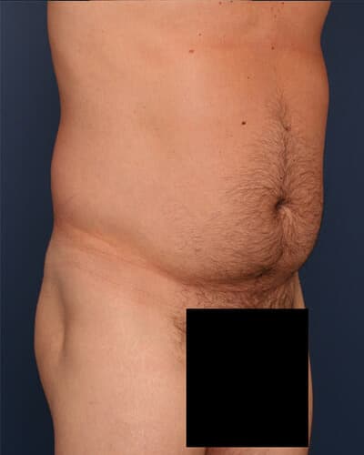 Before Image: Fat Grafting - right-front-oblique