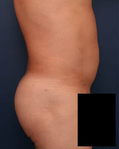 After Image: Fat Grafting - right-side