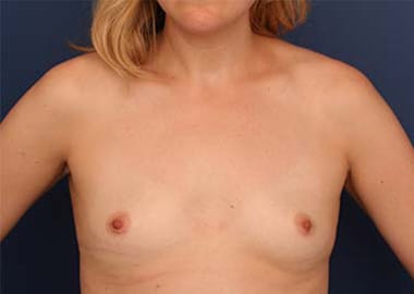 Before Image: Fat Grafting - front