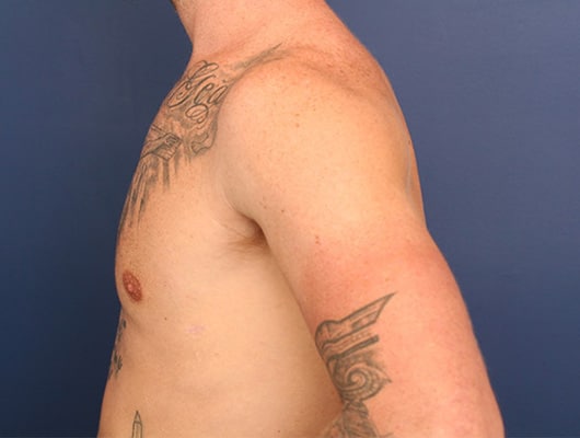 After Image: Gynecomastia - left-side