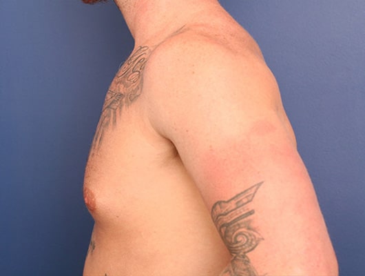 Before Image: Gynecomastia - left-side
