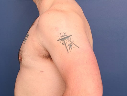 After Image: Gynecomastia - left-side