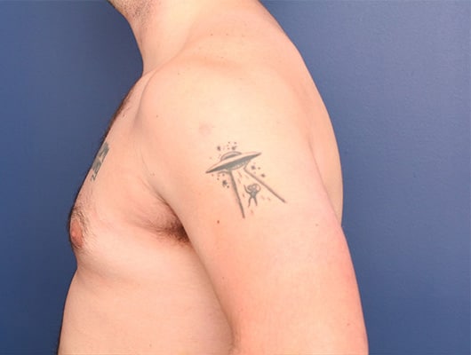Before Image: Gynecomastia - left-side