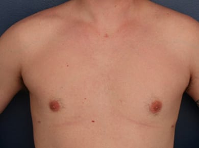 After Image: Gynecomastia - front