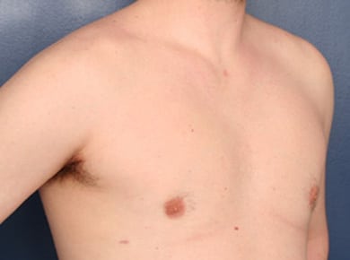 After Image: Gynecomastia - right-front-oblique