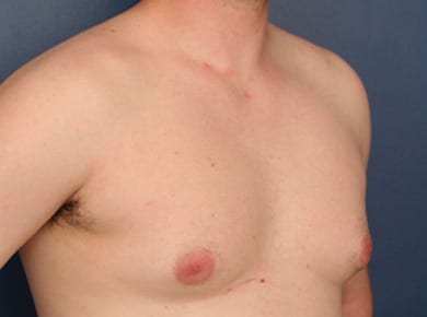 Before Image: Gynecomastia - right-front-oblique