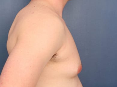 Before Image: Gynecomastia - right-side