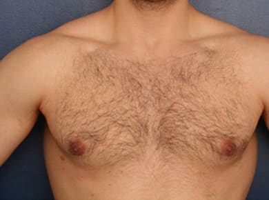 After Image: Gynecomastia - front