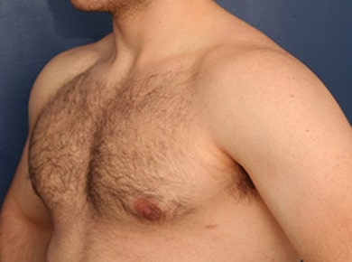 After Image: Gynecomastia - left-front-oblique