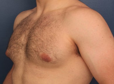 Before Image: Gynecomastia - left-front-oblique