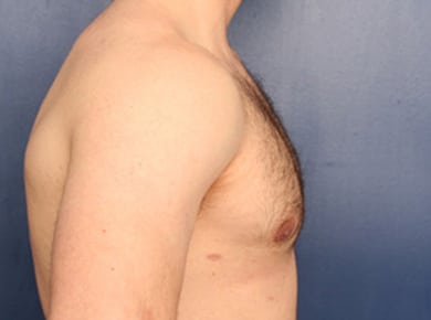 After Image: Gynecomastia - right-side
