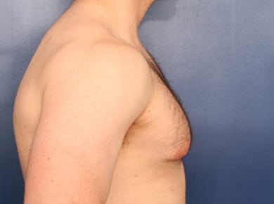 Before Image: Gynecomastia - right-side