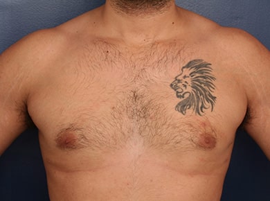 After Image: Gynecomastia - front
