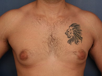 Before Image: Gynecomastia - front