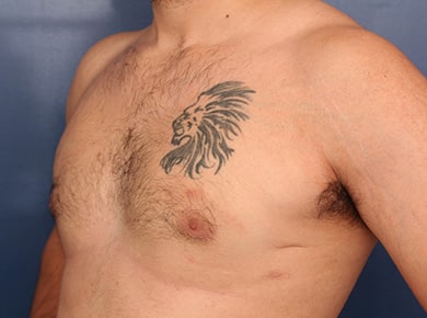 After Image: Gynecomastia - left-front-oblique