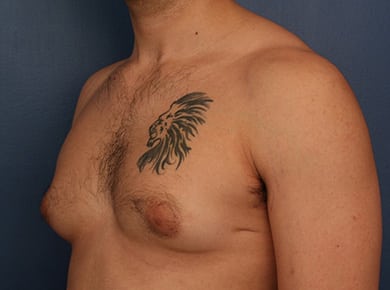 Before Image: Gynecomastia - left-front-oblique