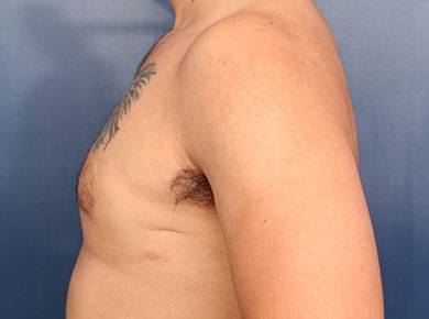 After Image: Gynecomastia - left-side