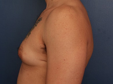 Before Image: Gynecomastia - left-side