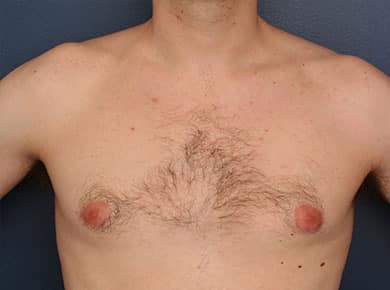 Before Image: Gynecomastia - front