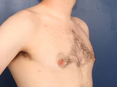 After Image: Gynecomastia - right-front-oblique