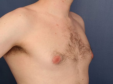 Before Image: Gynecomastia - right-front-oblique