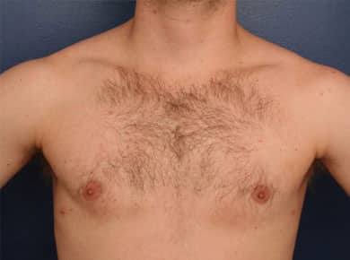 After Image: Gynecomastia - front