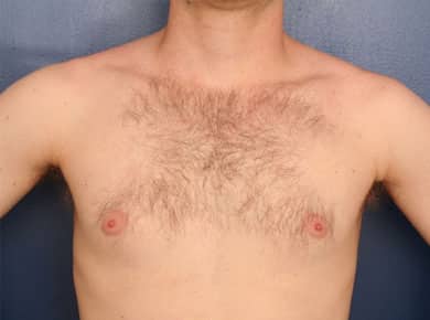 Before Image: Gynecomastia - front