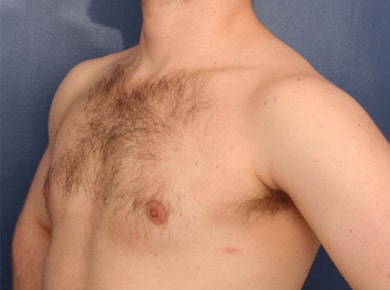 After Image: Gynecomastia - left-front-oblique