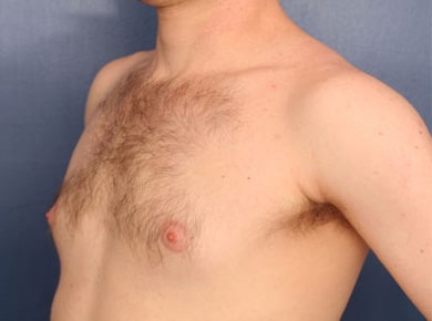 Before Image: Gynecomastia - left-front-oblique