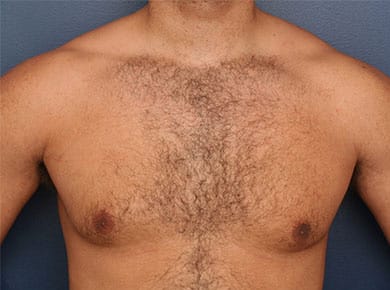 Before Image: Gynecomastia - front