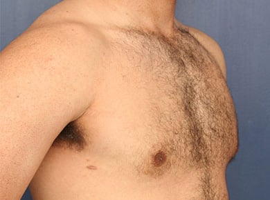 After Image: Gynecomastia - right-front-oblique
