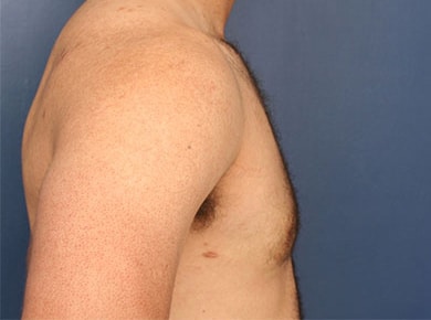 After Image: Gynecomastia - right-side