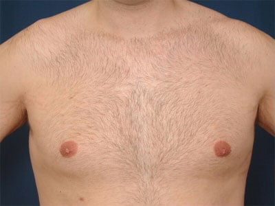 After Image: Gynecomastia - front