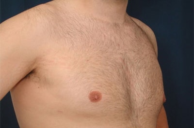 After Image: Gynecomastia - right-front-oblique