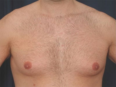 Before Image: Gynecomastia - front