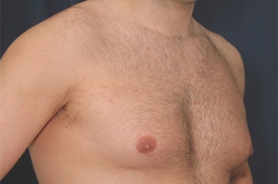 Before Image: Gynecomastia - right-front-oblique