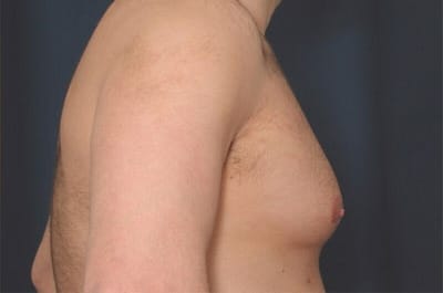 Before Image: Gynecomastia - right-side