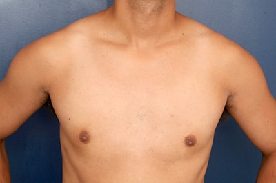 After Image: Gynecomastia - front
