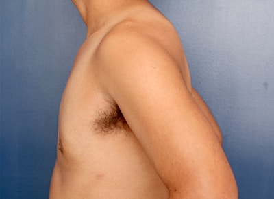 After Image: Gynecomastia - left-side