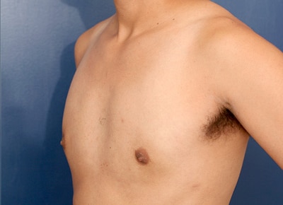 After Image: Gynecomastia - left-front-oblique