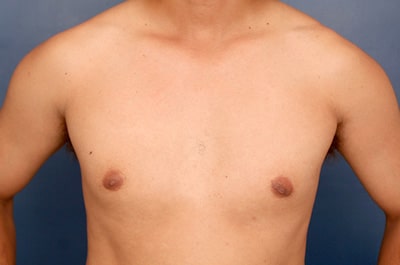 Before Image: Gynecomastia - front