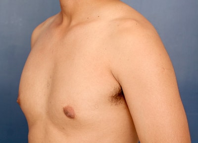 Before Image: Gynecomastia - left-front-oblique
