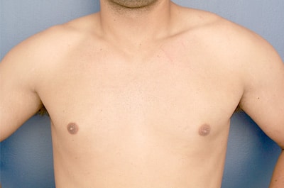 After Image: Gynecomastia - front
