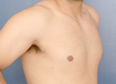 After Image: Gynecomastia - right-front-oblique