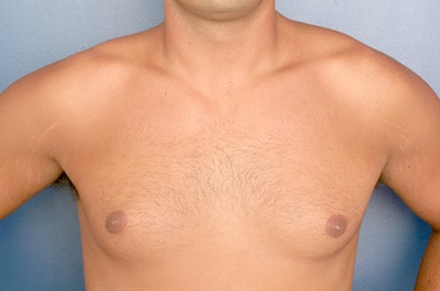 Before Image: Gynecomastia - front