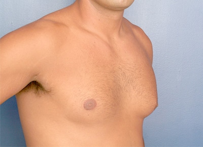 Before Image: Gynecomastia - right-front-oblique