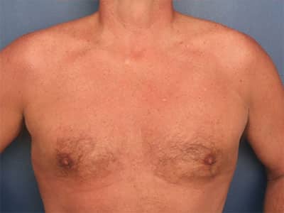 After Image: Gynecomastia - front